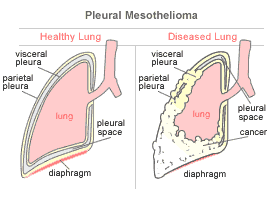 Pleural Mesothelioma as compared to a healthy lung.